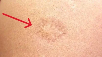 Pek çok kişinin sol kolunun üst kısmında yer alan ve